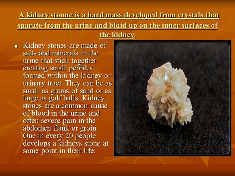 A kidney stoune is a hard mass developed from crystals that sparate from the